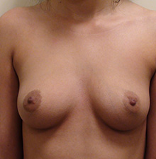 Breast Augmentation before 3