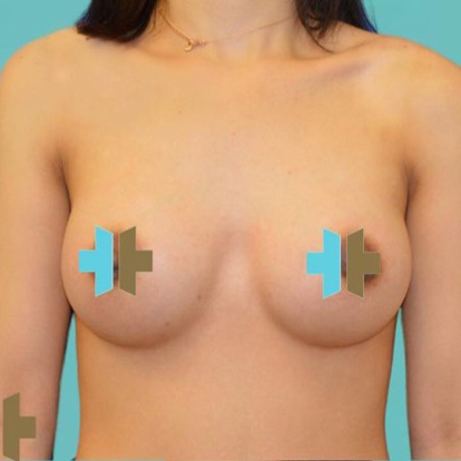 Breast Augmentation after 25