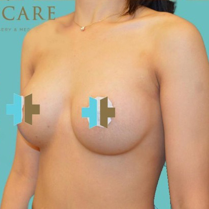 Breast Augmentation after 1