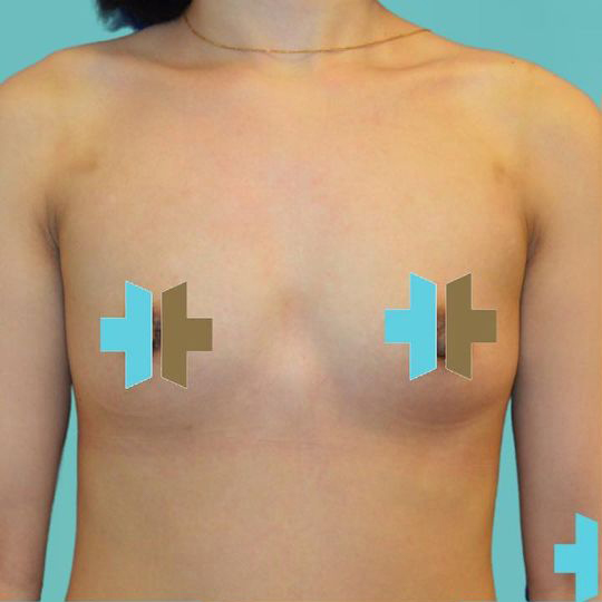 Breast Augmentation before 26