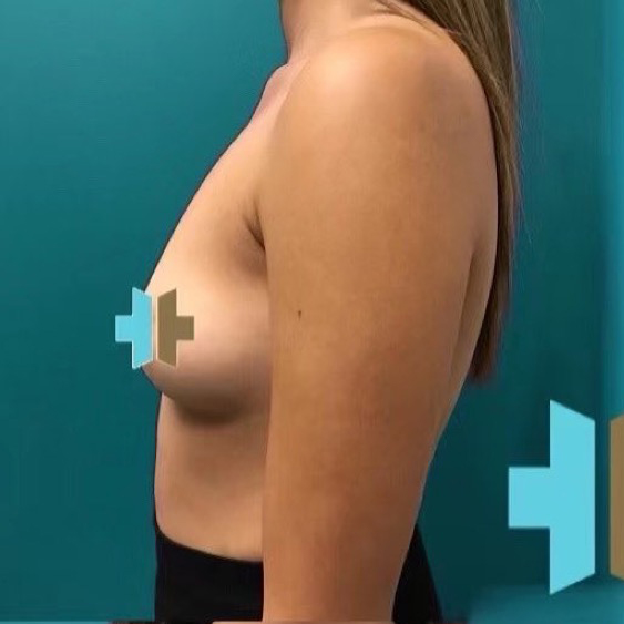 Breast Augmentation before 28