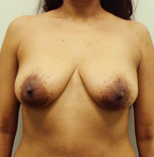 Breast Lift before 2