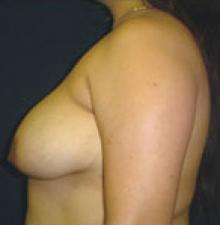 Breast Lift before 9