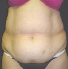 Liposuction before 2
