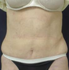 Liposuction after 2