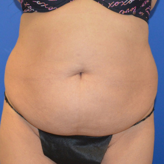 Abdominoplasty before 16