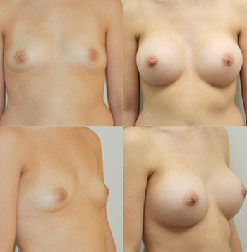Best Breast Augmentation Inland Empire