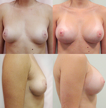 Breast Augmentation in Rancho Cucamonga