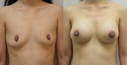 Breast Augmentation Inland Empire