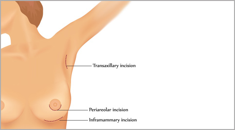 Breast Surgery Incision Options