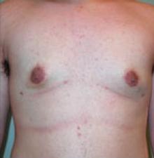 Male Cosmetic Surgery after 0