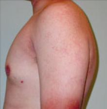 Male Cosmetic Surgery after 1