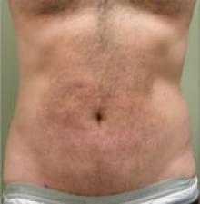 Male Cosmetic Surgery after 1