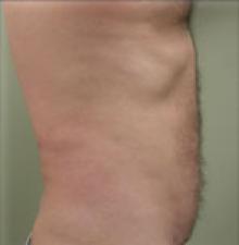 Male Cosmetic Surgery after 1