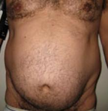 Male Cosmetic Surgery before 2
