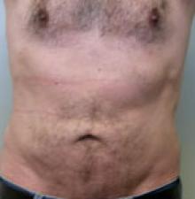 Male Cosmetic Surgery after 2