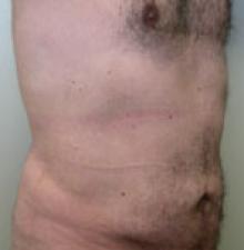 Male Cosmetic Surgery after 1