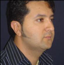 Male Cosmetic Surgery after 1