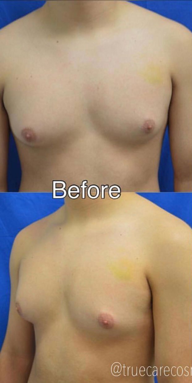 Male Cosmetic Surgery before 5