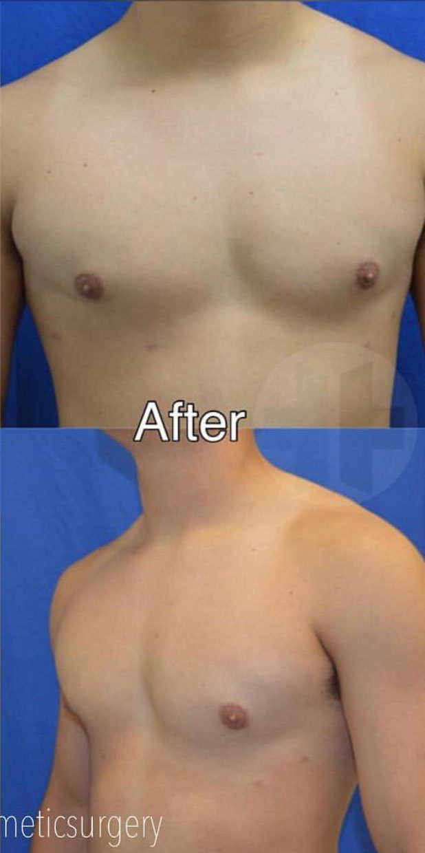 Male Cosmetic Surgery after 5