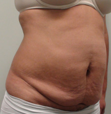 Abdominoplasty before 1