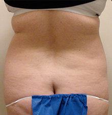 Liposuction before 2