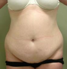 Liposuction before 3