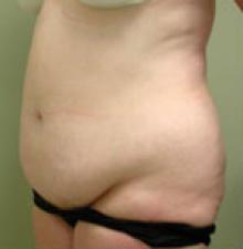 Liposuction before 1