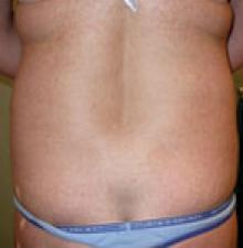 Liposuction before 5