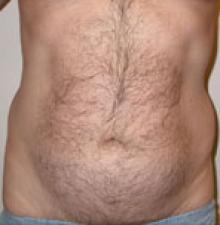 Liposuction before 6
