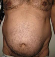 Liposuction before 7