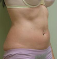 Liposuction before 1