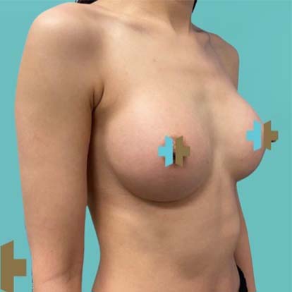 Breast Augmentation after 0