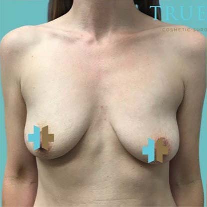 Breast Augmentation before 1
