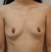 Breast Augmentation before 2