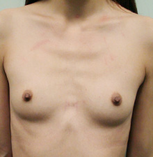 Breast Augmentation before 8