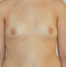 Breast Augmentation before 9