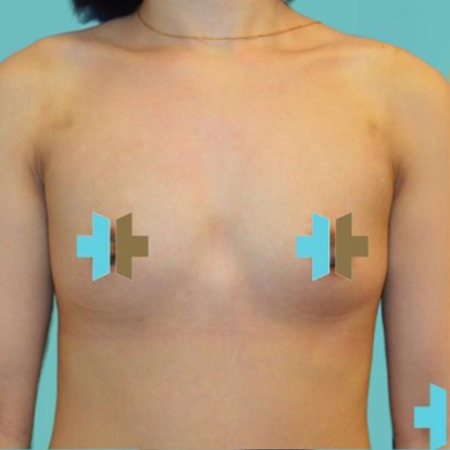 Breast Augmentation before 25