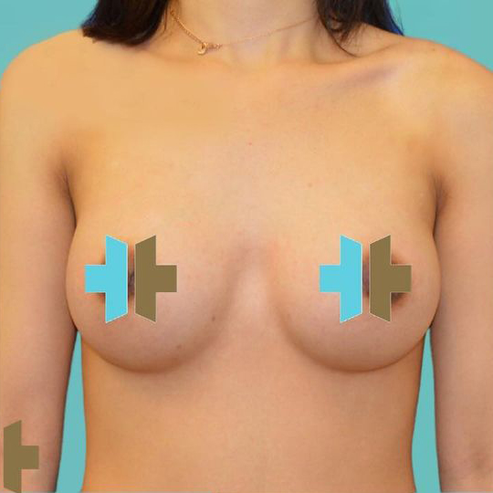 Breast Augmentation after 26