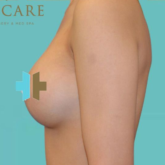 Breast Augmentation after 1