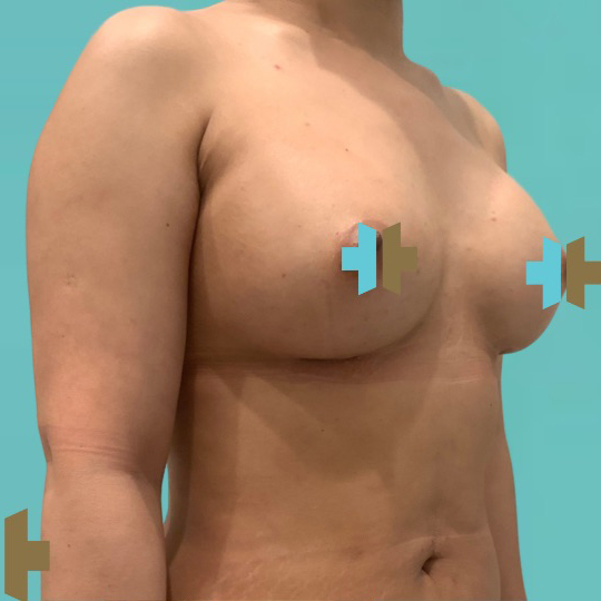 Breast Augmentation after 27