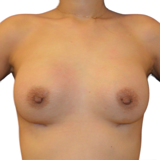 Breast Augmentation after 29