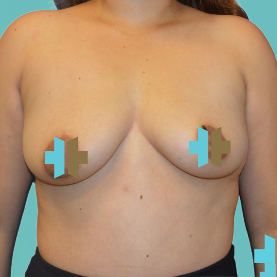 Breast Augmentation before 30