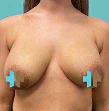 Breast Lift before 0