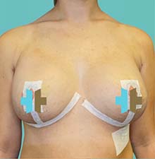 Breast Lift after 0
