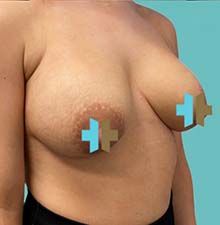 Breast Lift before 1
