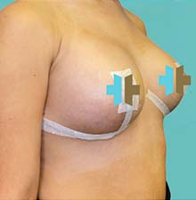 Breast Lift after 1