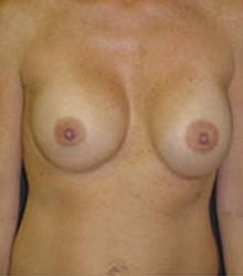 Breast Revision before 0