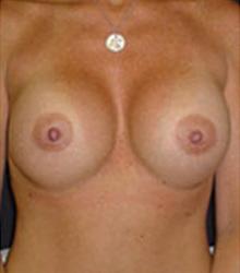 Breast Revision after 0