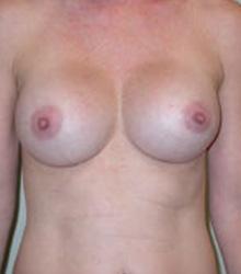 Breast Revision after 1